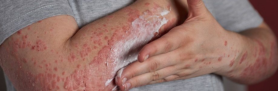 Dr. Arun Radhesh: A Global Specialist in Psoriasis