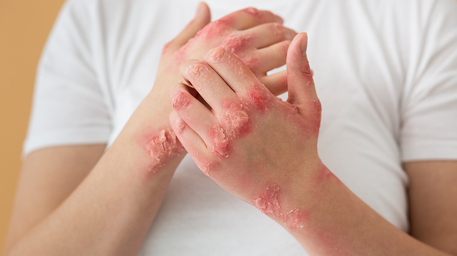 psoriasis-treatment